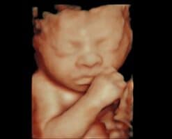 Reino Unido legaliza el aborto de nonatos con síndrome de Down